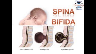 Spina Bifida les Causes et la Prévention par acide folique vitamine B9 [upl. by Alhahs]