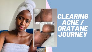 Clearing My AcneDark Spots amp Oratane Journey  Side Effects  South African YouTuber  vlogmas [upl. by Milks]