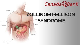 ZollingerEllison syndrome [upl. by Ahsaten]