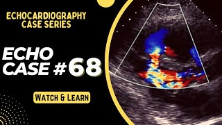 Echocardiography Case 68 Echo Spot Diagnosis Series  Echo Interpretation Made Easy [upl. by Harriman]