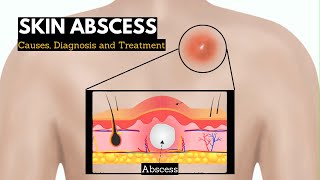 Skin Abscess Causes Signs and Symptoms Diagnosis and Treatment [upl. by Eerrehs]