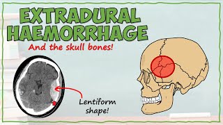 Anatomy of an Extradural Haemorrhage [upl. by Aicilat66]