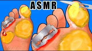 ASMR Foot Treatment  Removing Thick Dead Skin Calluses and Plantar Warts Animation  Tingle Sound [upl. by Hanoy797]