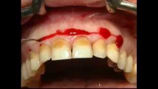 Gingival Surgery  External Bevel [upl. by Asyal824]