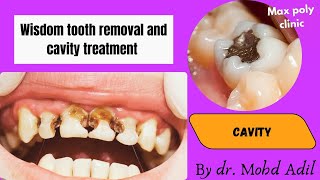 wisdom tooth removal and cavity treatment  3d animation  maxpolyclinic [upl. by Llerrac]