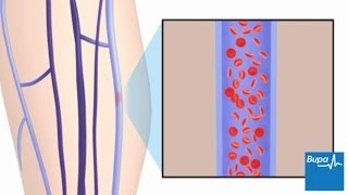 How superficial thrombophlebitis develops [upl. by Teeter]