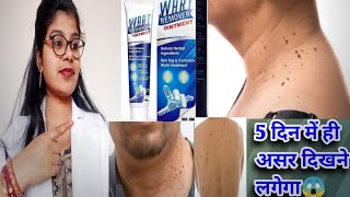 Wart Remover Ointment Honest Review2024Wart Remover ointment best usesampside effects review inhindi [upl. by Arehc]