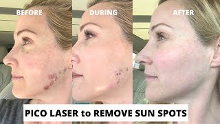 Pico Laser Treatment to Remove Sun Spots Before and After  With Dr Stefani Kappel MD EP039 [upl. by Faulkner]