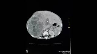 Hepatoblastoma before treatment [upl. by Doak403]