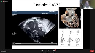 AV Canal Defect Echo evaluation by Dr K Sivakumar sir [upl. by Riedel]