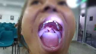 Orticochea Palatoplasty Cleft Palate Secondary Surgery 2 [upl. by Uy]