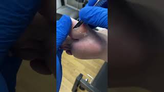 Watch as our Australian podiatrist tackles a big toe callus FootCareDownUnder CallusRemoval [upl. by Dlanar]