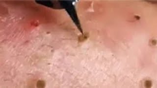 Full Giant Blackheads Popping Video Blackheads Removal 2019 [upl. by Mechelle]