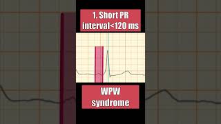 PR INTERVAL normal in AV block WPW pericarditis and atrial ischemia [upl. by Damita]