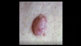 What are keloid scars and how to treat them [upl. by Ytiak]