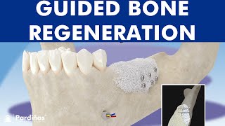 Guided bone regeneration  Bone graft © [upl. by Brooke8]