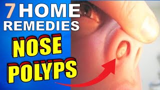 7 Natural Treatments amp Home Remedies For Nasal Polyps [upl. by Nnoryt707]