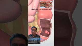 Colon Cancer surgery I Treatment for Colon cancer in Delhi Noida [upl. by Inimod]