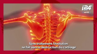 LA MINUTE SANTE  La polyarthrite rhumatoïde origines symptômes et traitements [upl. by Irahc]