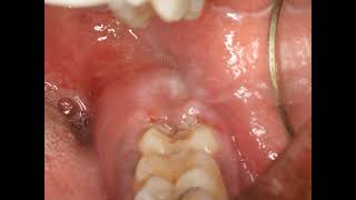 Operculectomy procedure with blade Painful swollen gum around wisdom tooth Pericoronitis Treatment [upl. by Cowie]