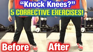 quotKnock Kneesquot Genu Valgum 5 BEST CORRECTIVE EXERCISES  Dr Wil amp Dr K [upl. by Howard]