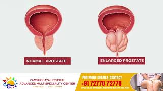 Understanding Frequent Micturition Dr Somashekar  Vamshodaya Hospitals [upl. by Hanfurd]