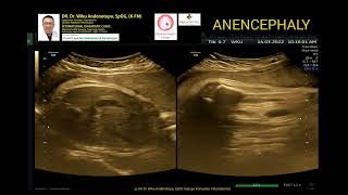 Anencephaly 33 weeks [upl. by Persson]