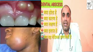 दॉतों में पस से कैसे पायें छुटकारा  Dental Abscess treatment  Dental Abscess types  Dental Absces [upl. by Ossie]