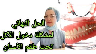 الحل النهائي لمشكلة دخول الأكل تحت طقم الأسنان المتحرك الكامل أو الجزئي Prothèse dentaire amovible [upl. by Weinreb973]