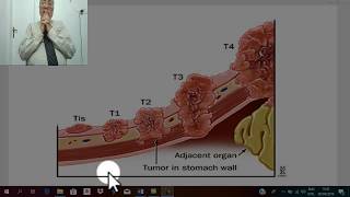 GIT tumors 5  carcinoma of stomach 1  pathology   by Dr Wahdan [upl. by Aala]