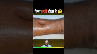 Pitting Edema causes 🤔medical shorts 💥🔥futuredr facts trending viralvideo neet facts yt😱 [upl. by Kathlin155]