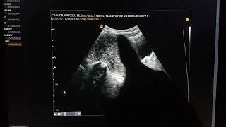 Adenomyosis Sonographic Findings [upl. by Demeyer374]