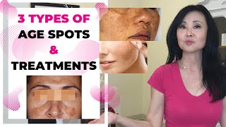 Age Spots vs Skin Cancer 3 Types [upl. by Scales898]