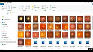 Glaucoma Detection Based on Joint Optic Disc and Cup Segmentation Using Dense Prediction Transformer [upl. by Bekki15]