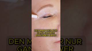 Hängende Oberlider ausgleichen eyelidlift eyelid plasticsurgery plasticsurgeon [upl. by Dachy]