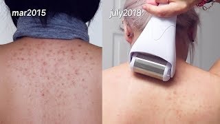 microneedling my acne scars 5 years of horrific acne [upl. by Laurie625]