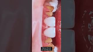 fundas de EMAX disilicato de litio dientes [upl. by Duong]