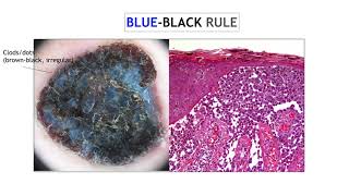 Nodular melanoma  Dr Ketty Peris [upl. by Tengdin]