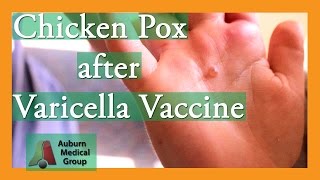 Chicken Pox after Varicella Vaccine  Auburn Medical Group [upl. by Koss]