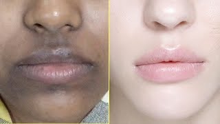 How To Remove Dark Black patches Dark SpotsHyper pigmentation Around Your Mouth [upl. by Downes]