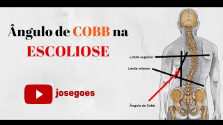 Ângulo de Cobb na Escoliose [upl. by Eltsyrk]