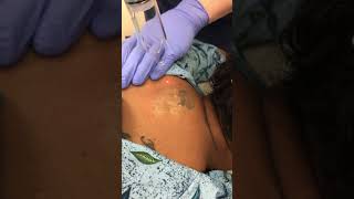 PiQo4 Advanced Laser Tattoo Removal [upl. by Freida]