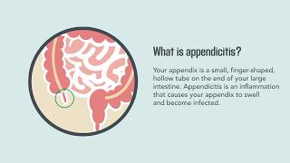 Appendicitis Symptoms Causes Diagnosis and Treatment  Merck Manual Consumer Version [upl. by Pik]