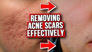 GET RID OF ACNE SCARS FROM EXPERIENCE [upl. by Arraik]