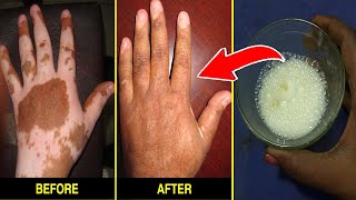 7 நாளில் வெண்புள்ளி மறைய வீட்டு வைத்தியம்  venpulli treatment in tamil [upl. by Christa]