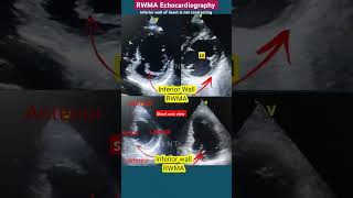 RWMA of Inferior Wall Echo clips l Part3 l हार्ट अटैक इको echo shorts [upl. by Ytitsahc]