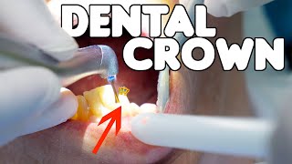 Dental Crown Procedure EXPLAINED [upl. by Nyrok567]