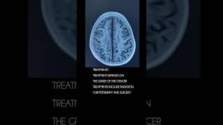 Glioblastoma cancer [upl. by Amand]