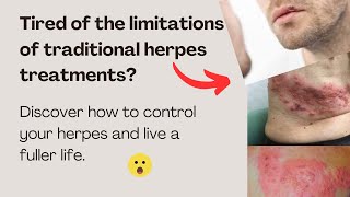 Natural supplements Herpes Relief Solution [upl. by Anerok]