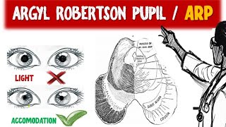 Exploring Argyl Robertson Pupil and ARP Syphilitic Pupil  Light near dissociation [upl. by Alexa]